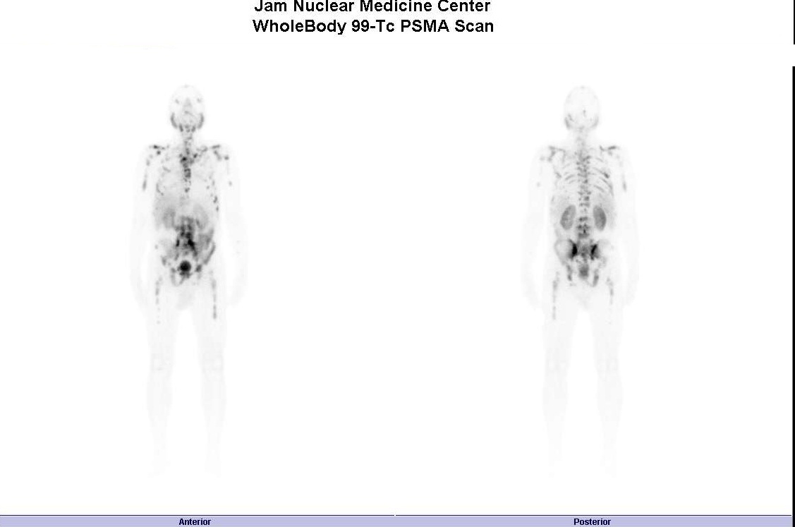 اسکن تشخیصی PSMA