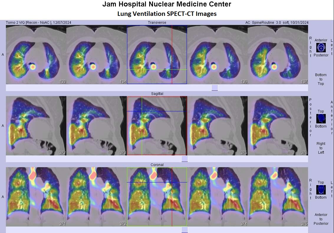 LUNG VENTILATION SPECT-CT